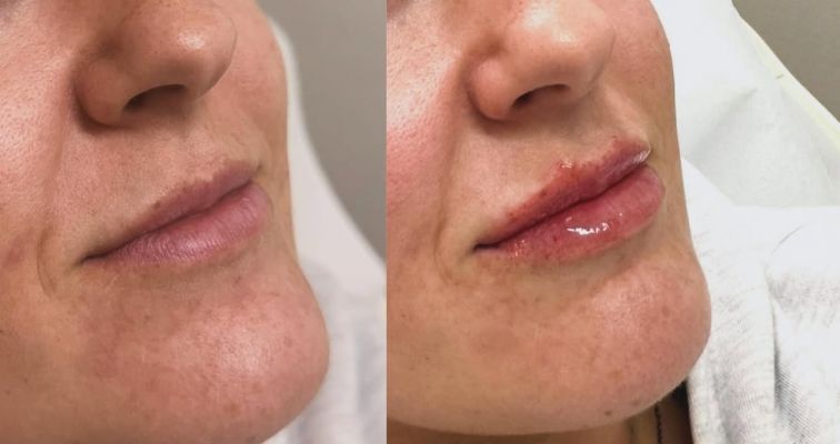 Photo of Lip filler 0.5ml