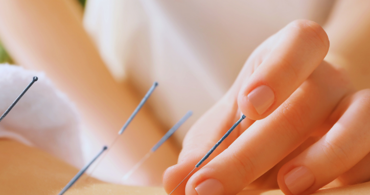 Photo of Acupuncture - Follow up Session