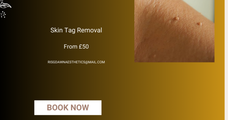 Photo of Lesion removal Skin Tag 